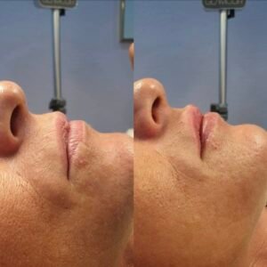 Mesofillers – Lipvolume & -therapie